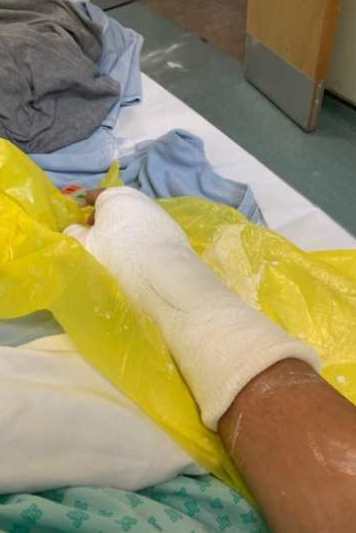 John's plastered arm
